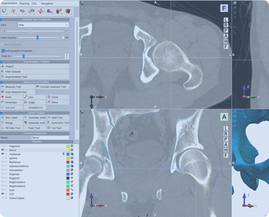 Precision 3D Hip-Preserving Solutions